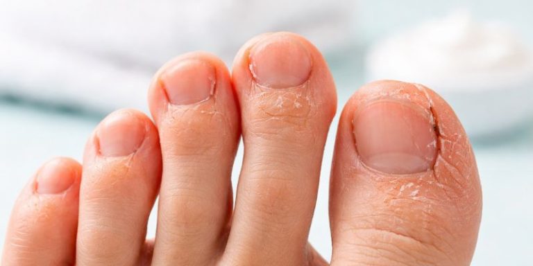 grietas entre dedos pies